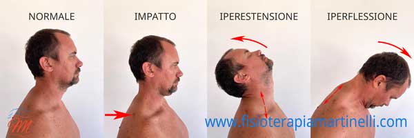 Colpo di frusta